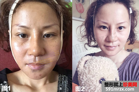 深圳鹏程整形医院拉皮鼻修复真实案例对比图