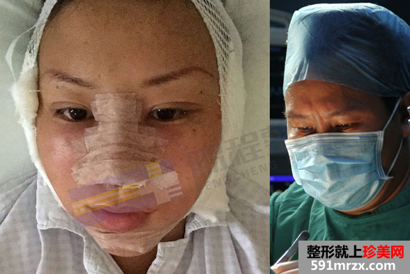 深圳鹏程整形医院拉皮鼻修复真实案例对比图
