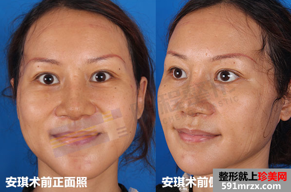 深圳鹏程整形医院拉皮鼻修复真实案例对比图