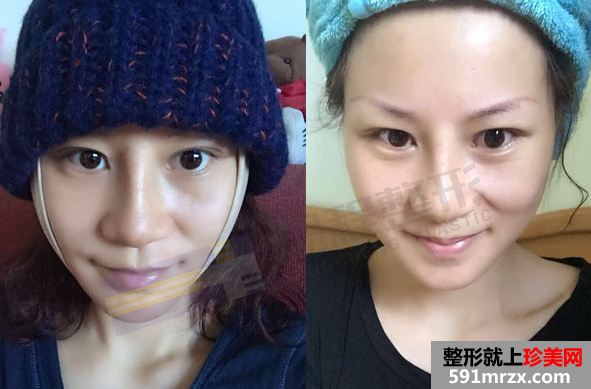 深圳鹏程整形医院拉皮鼻修复真实案例对比图