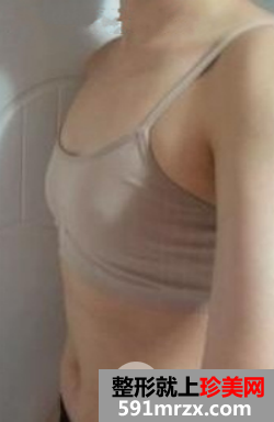 填充360cc硅胶假体隆胸后 穿吊带炒鸡性感!