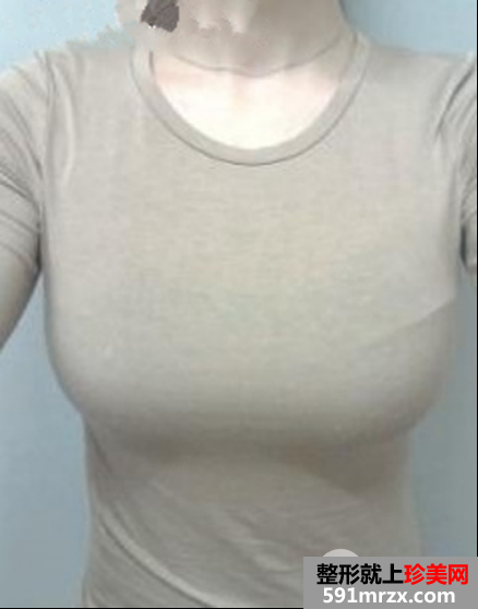 硅胶假体隆胸后