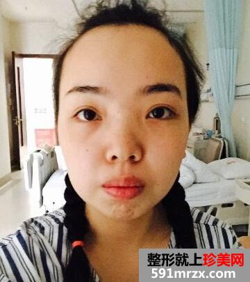 正颌+凸嘴矫正前后对比