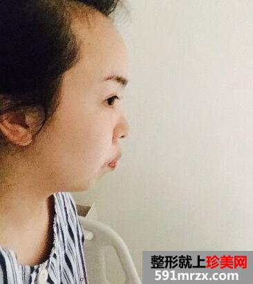 正颌+凸嘴矫正前后对比