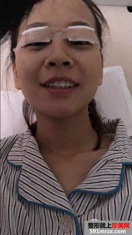 双眼皮整形手术前后恢复对比图照片分享