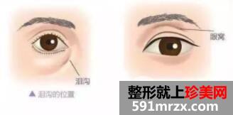 自体脂肪丰眼窝能维持多久了效果好不好