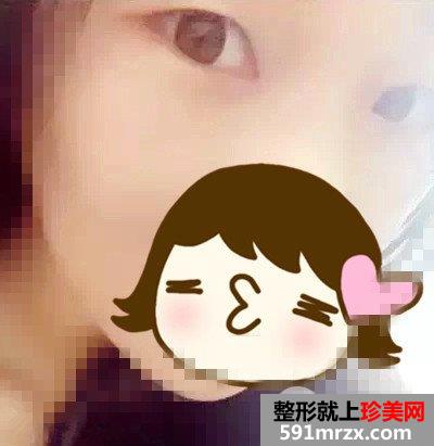 芭比娃娃双眼皮前后对比效果图片和恢复过程
