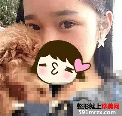 芭比娃娃双眼皮前后对比效果图片和恢复过程