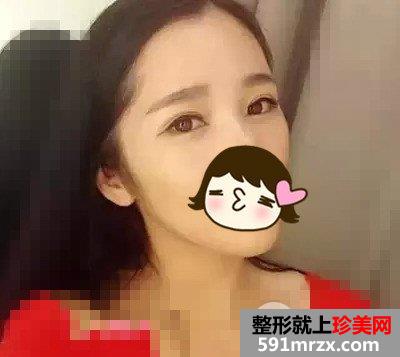 芭比娃娃双眼皮前后对比效果图片和恢复过程
