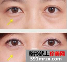 超声波去眼袋的效果如何？