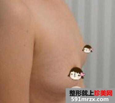 北京禾美嘉自体填充丰胸价格案例