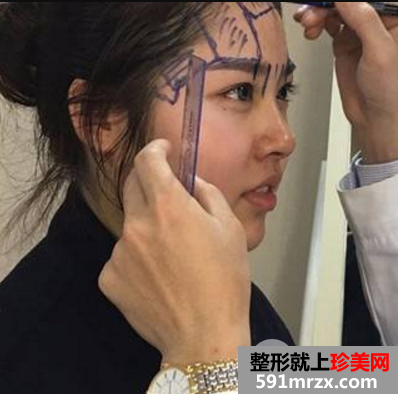 我都快变成整形达人了这次去做了自体脂肪填充太阳穴和额头