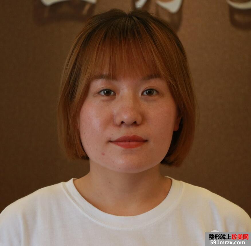 光纤溶脂瘦脸手术前后过程以及对比图，真实案例分享