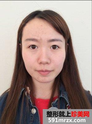 艾莉薇玻尿酸填充全脸案例效果分享,大饼脸小了一圈