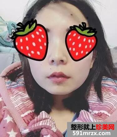 瘦脸针打几次定型？重庆美莱瘦脸针案例7天效果对比图