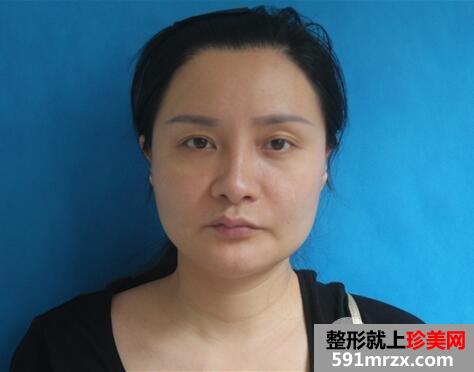 上海百达丽去颊脂垫瘦脸真实案例效果分享,和包子脸say拜拜