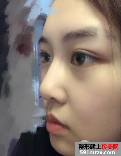 瘦脸针需要打几次？真实案例效果分享