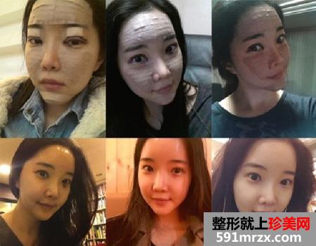 自体脂肪填充面部让我变身美少女