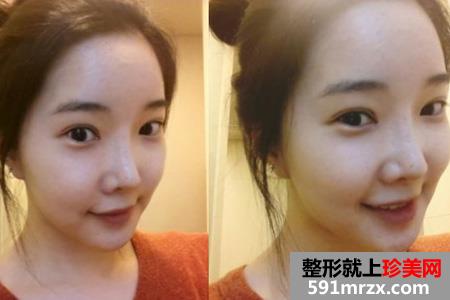 自体脂肪填充面部让我变身美少女