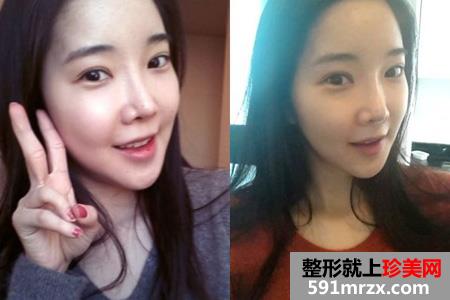 自体脂肪填充面部让我变身美少女