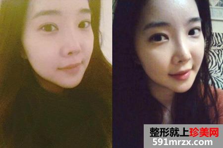 自体脂肪填充面部让我变身美少女