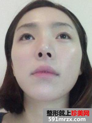 假体垫下巴+玻尿酸丰太阳穴恢复四个月记录