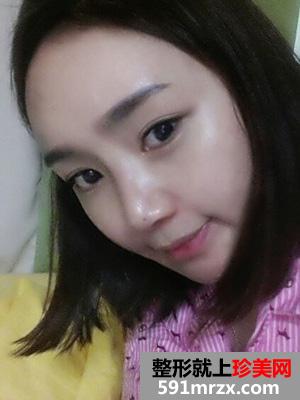 假体垫下巴+玻尿酸丰太阳穴恢复四个月记录
