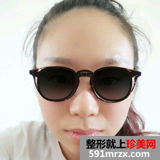 打瘦脸针除咬肌前后效果对比图和恢复过程