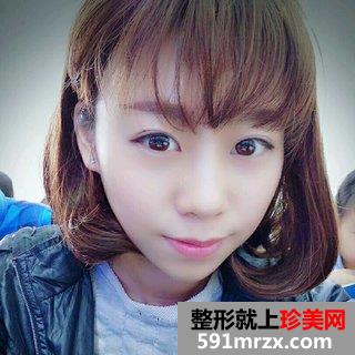 打瘦脸针除咬肌前后效果对比图和恢复过程