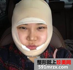 面部吸脂减肥 朋友不再叫我胖子脸