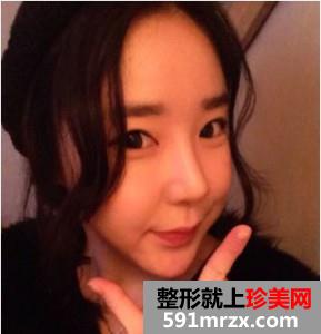 面部,吸脂,瘦脸,手术,恢复,过程,前后,对比,效果,图片