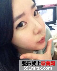 面部,吸脂,瘦脸,手术,恢复,过程,前后,对比,效果,图片