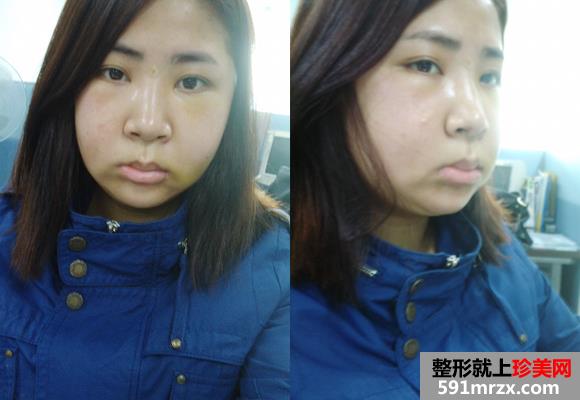 vline手术+面部精细吸脂瘦脸术真实案例分享和前后对比图