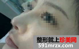 做了膨体+自体耳软骨隆鼻后 大家都说我比女神还女神