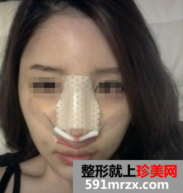 做了膨体+自体耳软骨隆鼻后 大家都说我比女神还女神