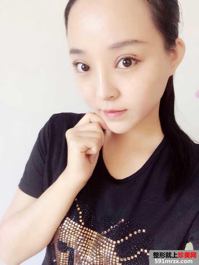 3度仿生美鼻+彩光祛雀斑+多维立体丰下颏前后对比效果图片