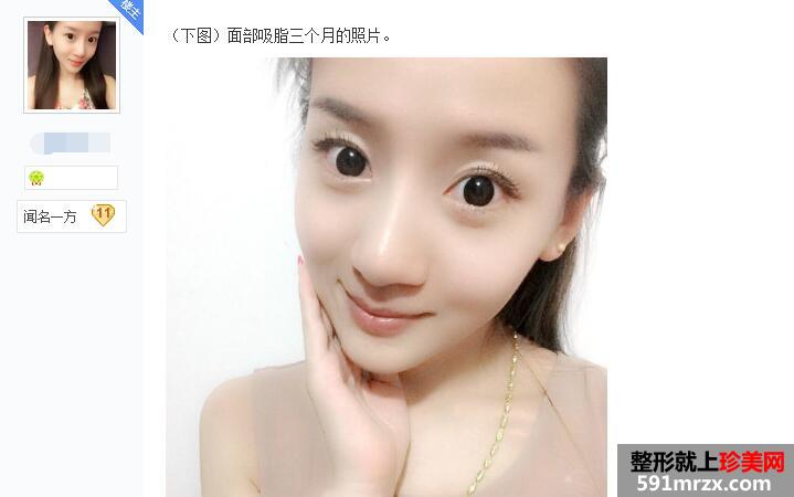 贴吧分享:面部吸脂减肥过程 有婴儿肥的看过来 贴吧分享:面部吸脂减肥过程 有婴儿肥的看过来