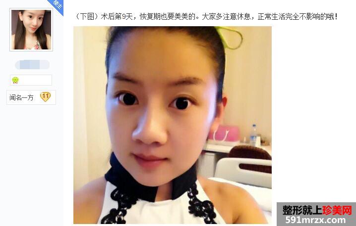 贴吧分享:面部吸脂减肥过程 有婴儿肥的看过来 贴吧分享:面部吸脂减肥过程 有婴儿肥的看过来