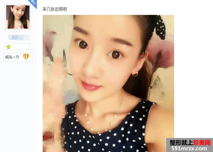 贴吧分享:面部吸脂减肥过程 有婴儿肥的看过来 贴吧分享:面部吸脂减肥过程 有婴儿肥的看过来