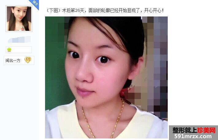 贴吧分享:面部吸脂减肥过程 有婴儿肥的看过来 贴吧分享:面部吸脂减肥过程 有婴儿肥的看过来