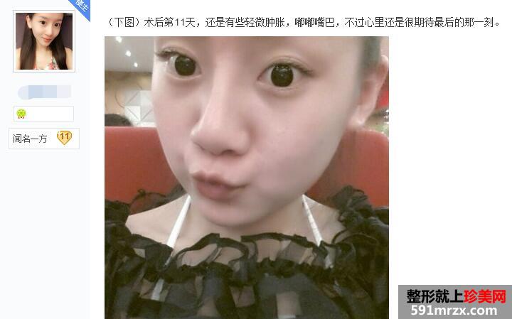 贴吧分享:面部吸脂减肥过程 有婴儿肥的看过来 贴吧分享:面部吸脂减肥过程 有婴儿肥的看过来