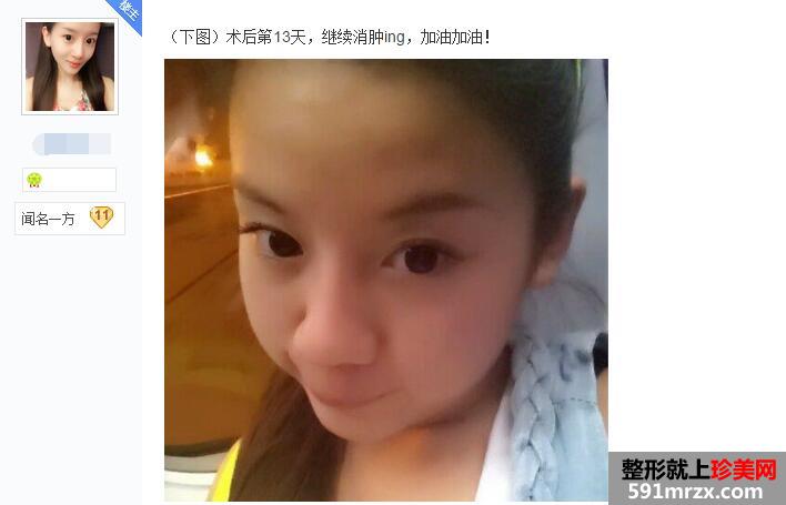 贴吧分享:面部吸脂减肥过程 有婴儿肥的看过来 贴吧分享:面部吸脂减肥过程 有婴儿肥的看过来