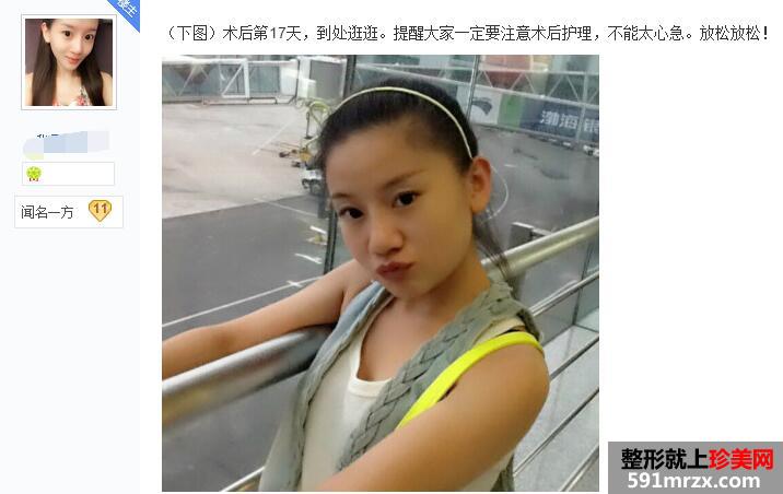 贴吧分享:面部吸脂减肥过程 有婴儿肥的看过来 贴吧分享:面部吸脂减肥过程 有婴儿肥的看过来