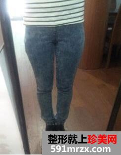 臀部吸脂术 超级无敌变身美少女 臀部吸脂术 超级无敌变身美少女