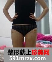 臀部吸脂术 超级无敌变身美少女 臀部吸脂术 超级无敌变身美少女