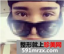 宁波,美莱,双眼皮,45天了,有图有真相哦