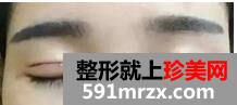 宁波,美莱,双眼皮,45天了,有图有真相哦