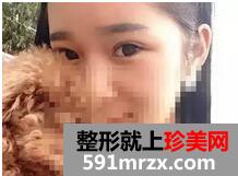 宁波,美莱,双眼皮,45天了,有图有真相哦