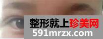 宁波,美莱,双眼皮,45天了,有图有真相哦