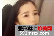 宁波,美莱,双眼皮,45天了,有图有真相哦